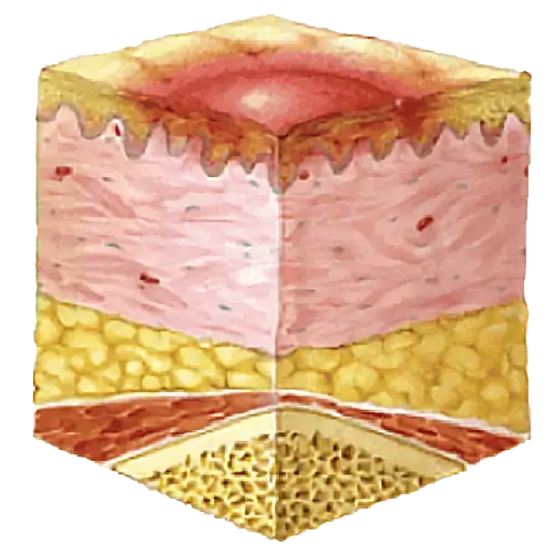 image showing the pressure ulcer stage one
