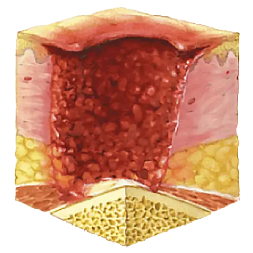 image showing pressure ulcer stage 4