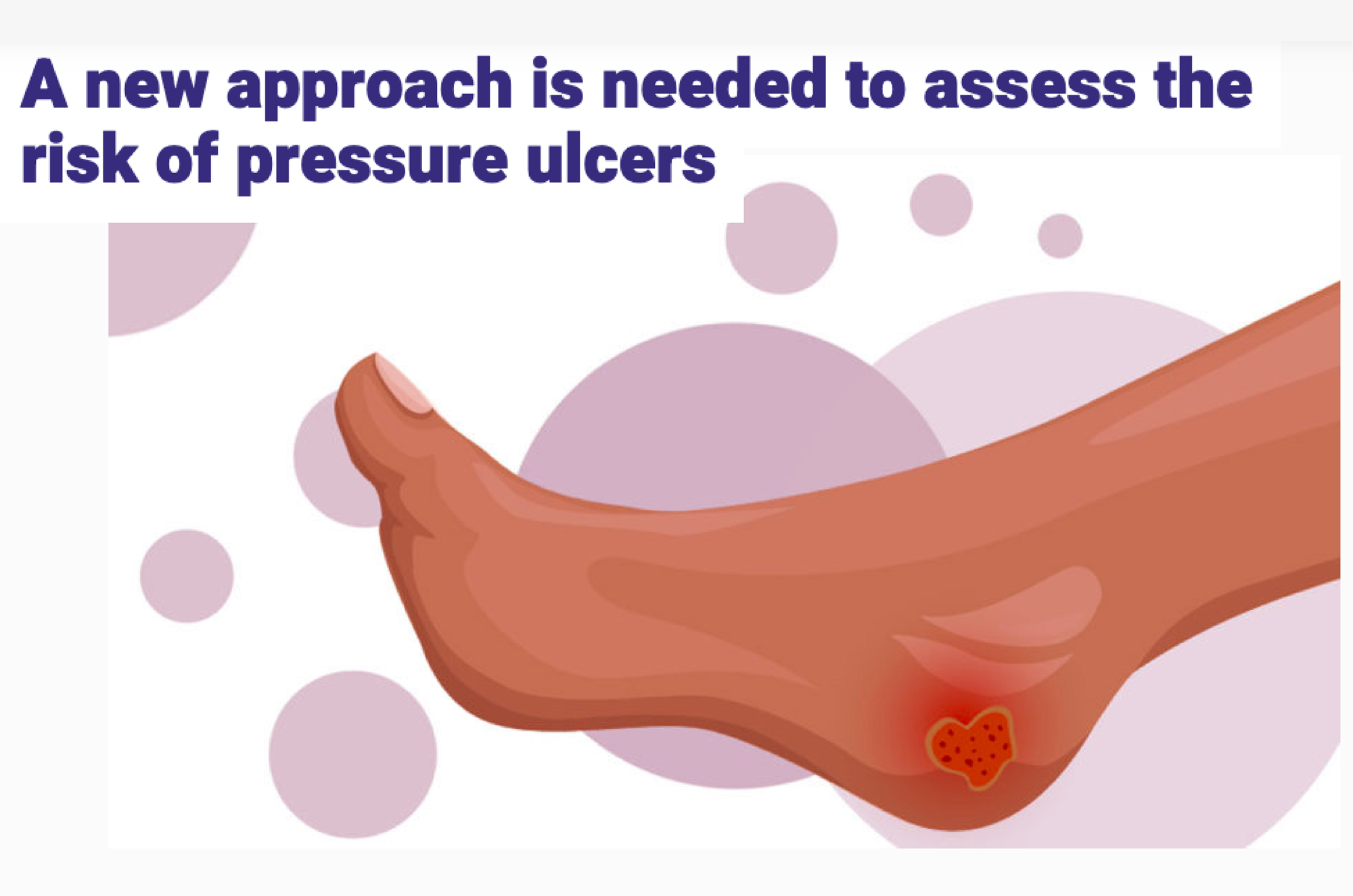 a new approach is needed to assess the risk of pressure ulcers