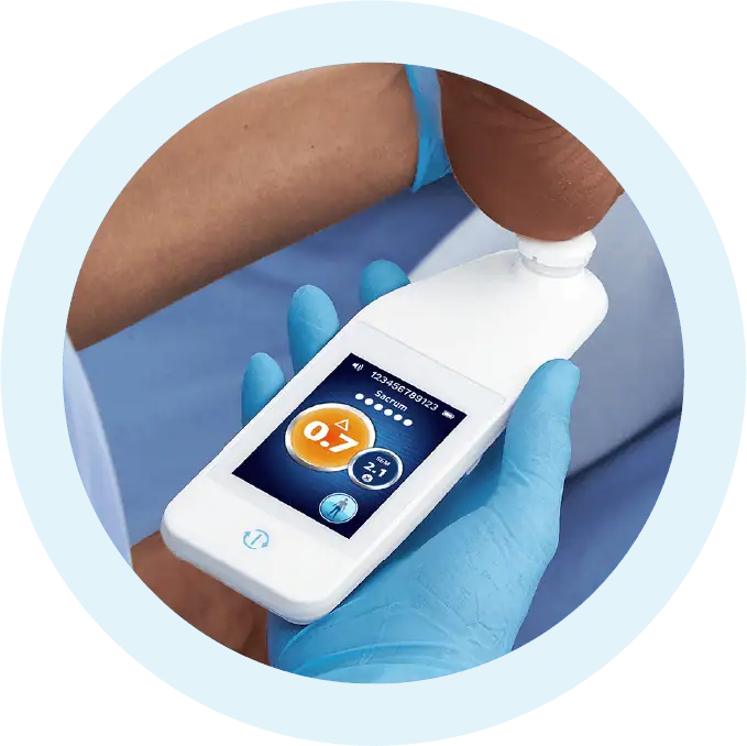 Close-up of a healthcare professional using a handheld SEM Scanner device on a patient's heel to assess sub-epidermal moisture, with the device screen displaying a reading.